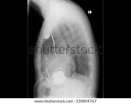 X-ray image of the breast. VergÃ?Â?Ã?Â¶Ã?Â??ertes heart with dilated cardiomyopathy. With implanted pacemaker system. Cardiac resynchronization therapy.