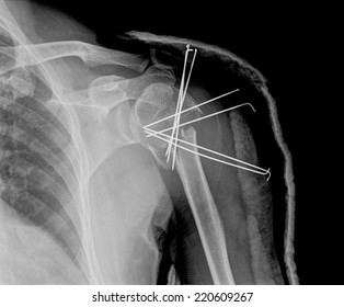 1,757 Humerus Fracture Images, Stock Photos & Vectors | Shutterstock