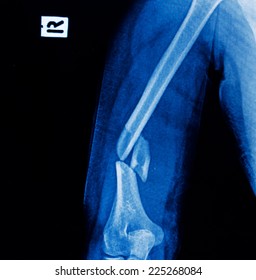 Xray Image Broken Arm Bone Show Stock Photo 225268084 | Shutterstock