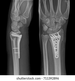 595 Distal Radius Fracture Images, Stock Photos & Vectors | Shutterstock