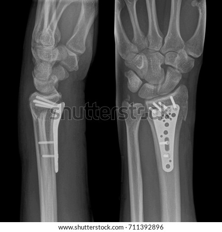 X-ray image of broken arm. Distal radius fracture fixation with screw & plate.