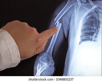 X-ray image of broken arm on monitor of pc. The doctor shows by  finger on a broken arm.