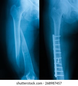 X-ray Image Of Broken Femur, Before And After Treating By Screws.