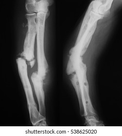 464 Osteomyelitis Images, Stock Photos & Vectors | Shutterstock