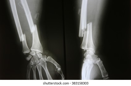 X-ray image of broken forearm, AP and lateral view show fracture of ulna and radius bone - Shutterstock ID 383158303