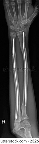 x-ray image of broken forearm Post Operative X ray of a child boy treated for radius ulna fracture