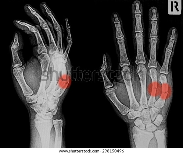 Xray Image Broken Hand Ap Oblique Stock Photo (edit Now) 298150496