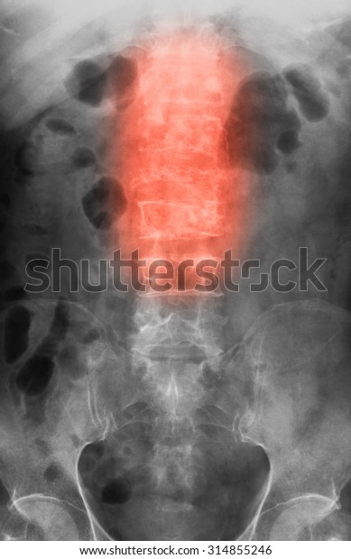 Xray Image Burst Fracture L1l3 Vertebrae Stock Photo (Edit Now) 314855246