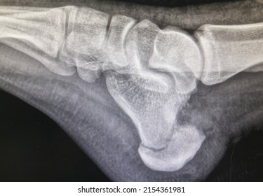 X-ray Image Of Calcaneus Fracture(broken Heel)