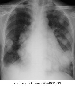 Xray Image Of Canon Ball Pulmonary Metastasis