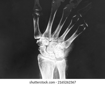 X-ray Image Of Carpals Bone ,AP View