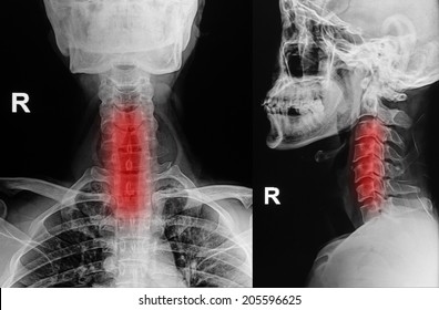 Cervical Spondylosis Images Stock Photos Vectors Shutterstock