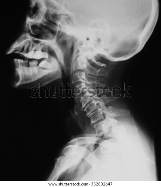 cervical spine x ray icd 10