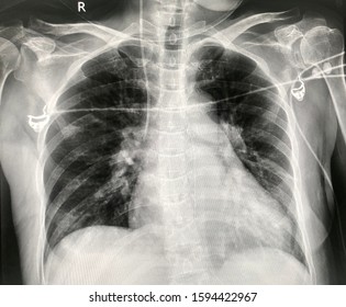 Xray Image Chest Bone Thorax Line Stock Photo 1594422967 | Shutterstock