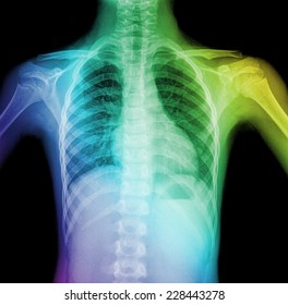 X-Ray Image Of Child Healthy Chest MRI