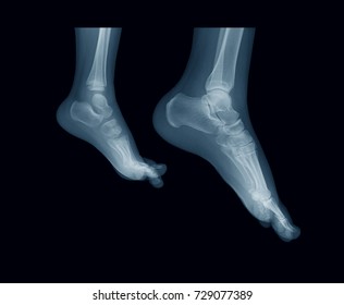 x-ray image of child (left) and adult foot (right), lateral view