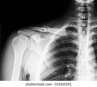 X-ray Image Of Clavicle. Clavicle Fracture.