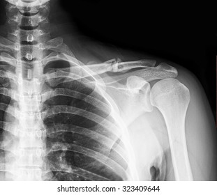 Xray Shoulder Joint Show Fracture Clavicle Stock Photo Shutterstock