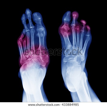 X-ray image of diabetic feet, posterior view show amputation toes and joint inflamed 