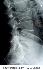 X-ray Image To Diagnose A Fracture Of The Spine