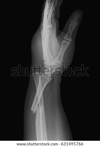 X-ray image of distal forearm include hand, lateral view, showing fracture of radius with distal ulnar joint dislocation 