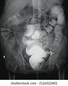 Xray Image Of Diverticulosis Colon,multiple Diverticle Colon