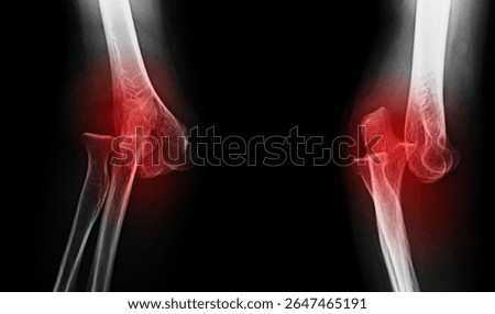 An x-ray image of elbow dislocation