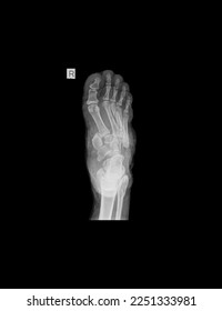 X-ray image of the foot bone showing a fracture of the foot bone. - Shutterstock ID 2251333981