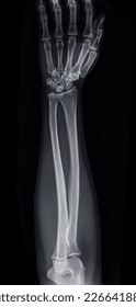 X-ray image of forearm bone. - Shutterstock ID 2266418809