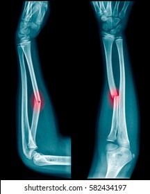 3,449 Broken arm xray Images, Stock Photos & Vectors | Shutterstock