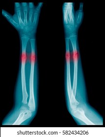 X-ray image of Forearm bone fracture in child's (Radius bone, Ulna bone)  - Shutterstock ID 582434206