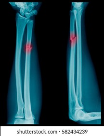 X-ray image of Forearm bone fracture in child's (Radius bone, Ulna bone)  - Shutterstock ID 582434239
