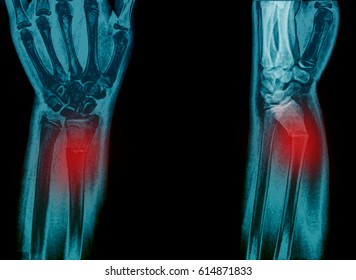 Xray Image Forearm Bone Fracture Radius Stock Photo (Edit Now) 614871833