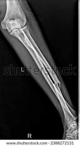 X-ray image of Forearm bone fracture (Radius bone, Ulna bone)