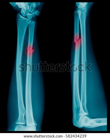 X-ray image of Forearm bone fracture in child's (Radius bone, Ulna bone) 