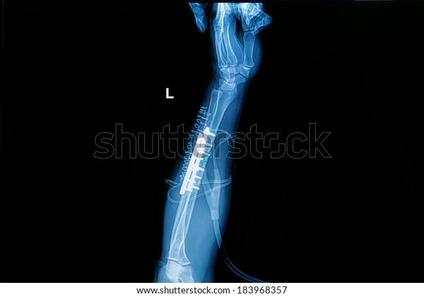 Xray Image Forearm Implant Plate Screw Stock Photo 183968357 Shutterstock