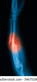 Xray Image Forearm Lateral View Show Stock Photo 346751006 | Shutterstock