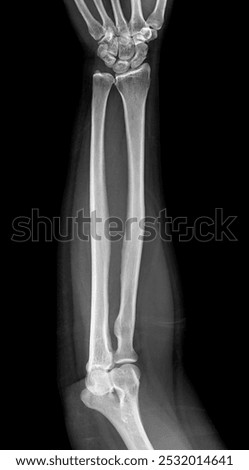 X-ray image of the forearm showing the radius and ulna bones in proper alignment, with no visible fractures or abnormalities.