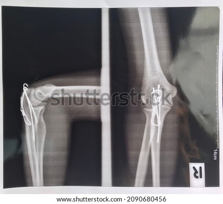 X-ray image of fractured right elbow joint from radiology imaging
