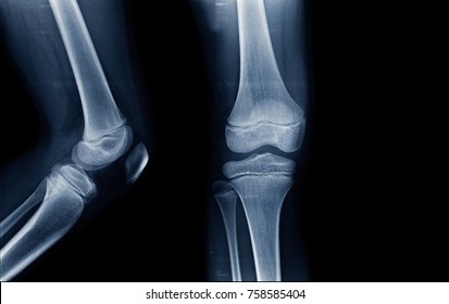 xray image full cartilage of knee joint