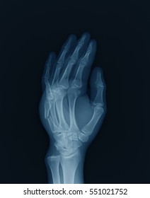 Xray Image Hand Oblique View Showing Stock Photo 551021752 | Shutterstock