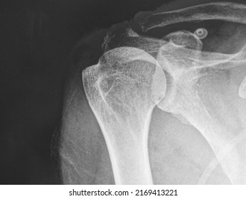 X-ray image , head of humerus