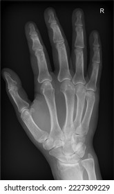 An X-Ray image of a healthy hand. - Shutterstock ID 2227309229