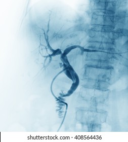 X-ray Image Of Hepatic Arteriogram, Antero-posterior(AP) View.