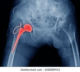 X-ray Image Hip Replacement, Total Hip Arthroplasty 