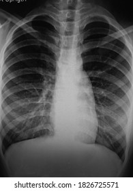 X Ray Chest Showing Central Venous Stock Photo (Edit Now) 759238225