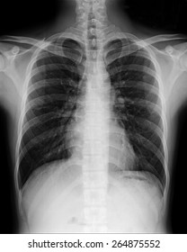 Film Chest Xray Pa Upright Copd Stock Photo 1588186699 | Shutterstock