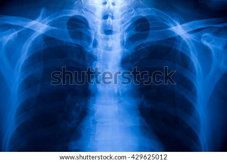 X-Ray Image Of Human Chest for a medical diagnosis.