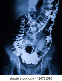 Xray Image Human Colon Medical Diagnosis Stock Photo 424751590 ...