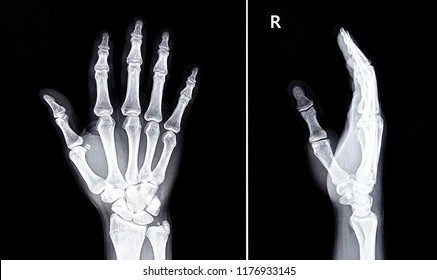 Radiographie Main Images Stock Photos Vectors Shutterstock